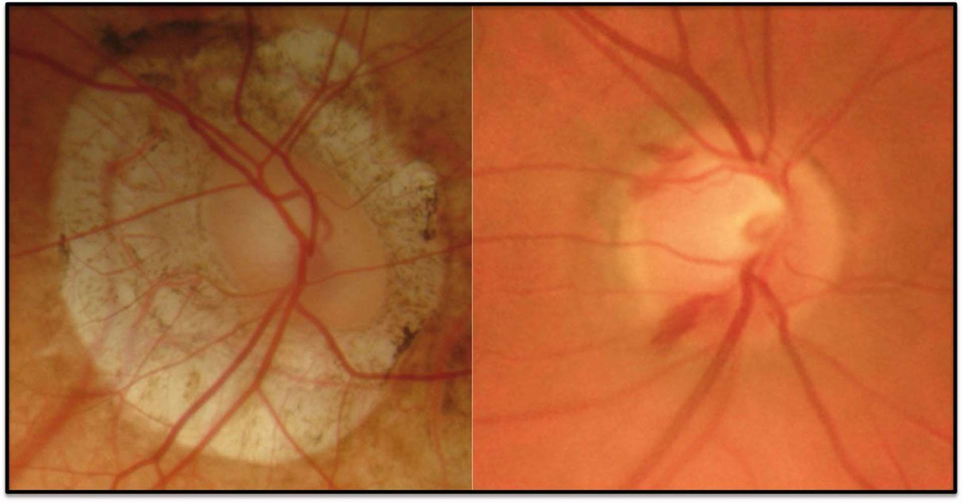 La papille du myope fort. À gauche : diamètre et rapport cup/disc augmentés, excavation peu profonde et plus large, insertion oblique, colobome, atrophie chorio-rétinienne, staphylome postérieur, situs inversus vasculaire. À droite : l’hémorragie parapapillaire doit faire suspecter fortement l’existence un glaucome sous-jacent.
