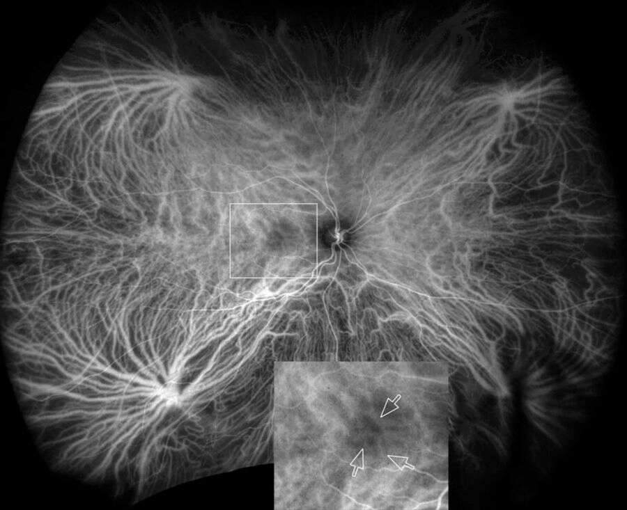 Figure 3. Angiographie ICG ultra grand champ d’un œil atteint d’une pachychoroïde (épaisseur choroïdienne rétrofovéale à 505 mm) montrant une anastomose des vortiqueuses entre les quadrants superonasal et inferonasal, ainsi qu’entre le quadrant supérotemporal et le quadrant inférotemporal. L’encart montre de larges veines choroïdiennes anastomotiques traversant la région maculaire.
