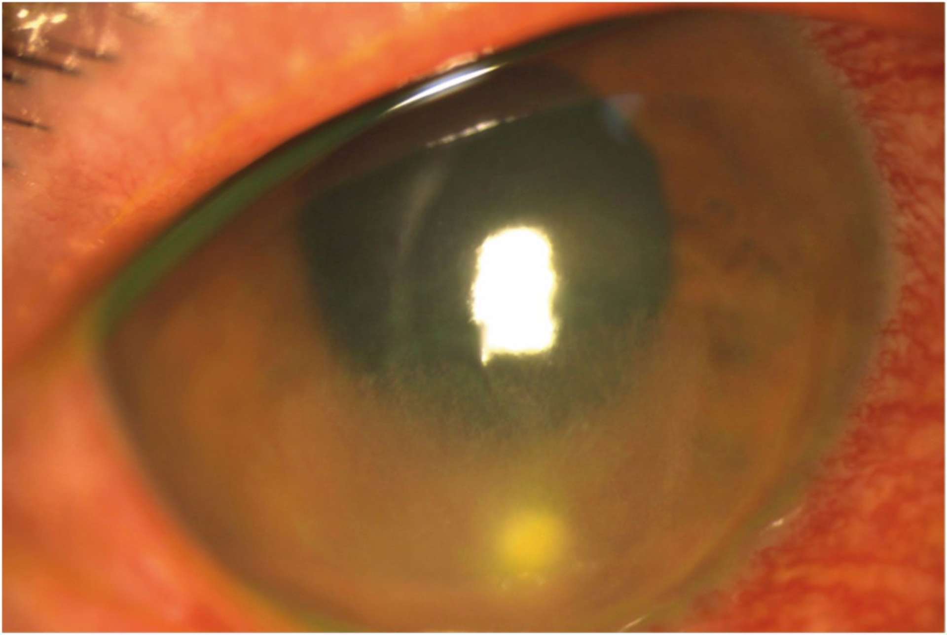 Figure 2. Association abcès + DLK : on distingue bien l’infiltrat infectieux inférieur et les lignes inflammatoires « comme des dunes de sable » à sa partie supérieure.  (Photo CHU de Bordeaux)
