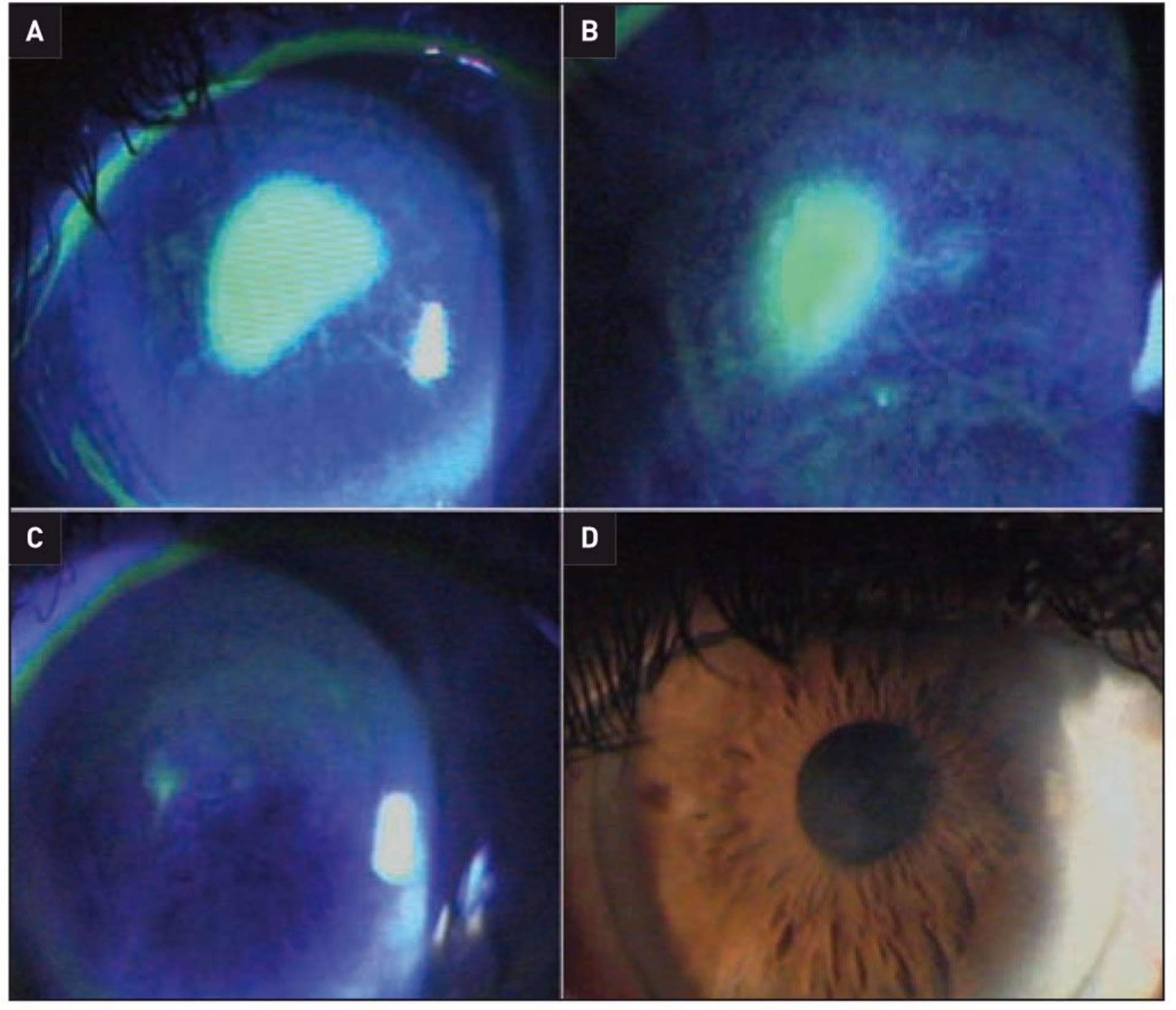 Figure 2. Kératite neutrophique persistante postcataracte avec régression de l’ulcération en 1 mois de traitement par Cacicol® (remerciements au Pr M. Labetoulle). A. Ulcération persistante à trois semaines de la chirurgie de la cataracte. B. Après 7 jours de traitement par Cacicol20®. C. Après 14 jours de traitement par cacicol20®. D. Après 1 mois de traitement par cacicol20®.
