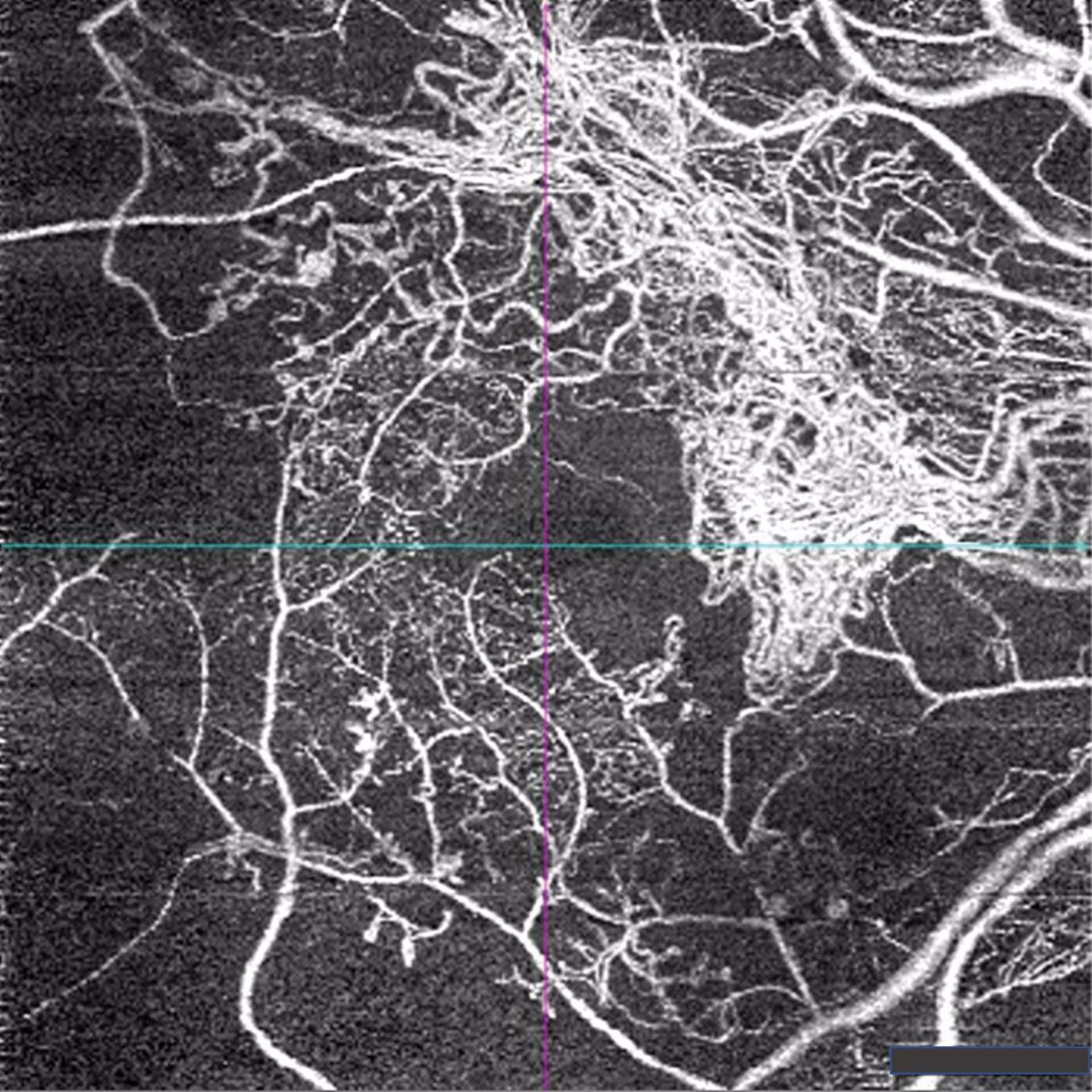 Figure 4. Néovaisseaux prérétiniens de l’œil droit en OCT-A chez une patiente diabétique de 68 ans présentant de vastes zones de non-perfusion avec ischémie maculaire : élargissement de la ZAC.
