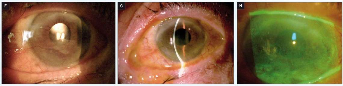La pose d’une lentille en lotrafilcon B à port continu pendant 30 jours (F) permet d’atténuer l’état inflammatoire cornéen, l’état trophique de la surface s’améliore (G et H).
