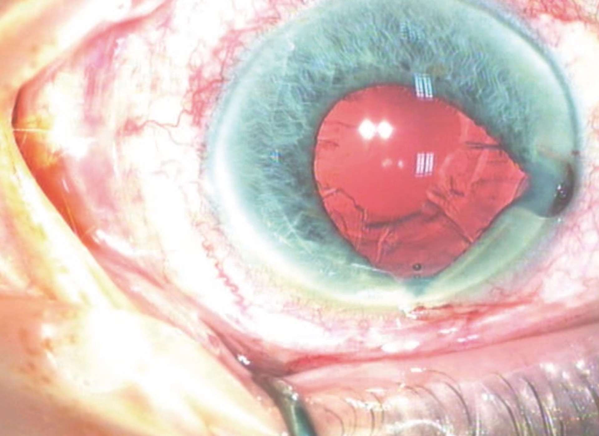 IFIS grade 3 (sévère) associant une flaccidité du bord pupillaire, une constriction irienne et un prolapsus avec une éversion de l’iris au travers des incisions cornéennes.
