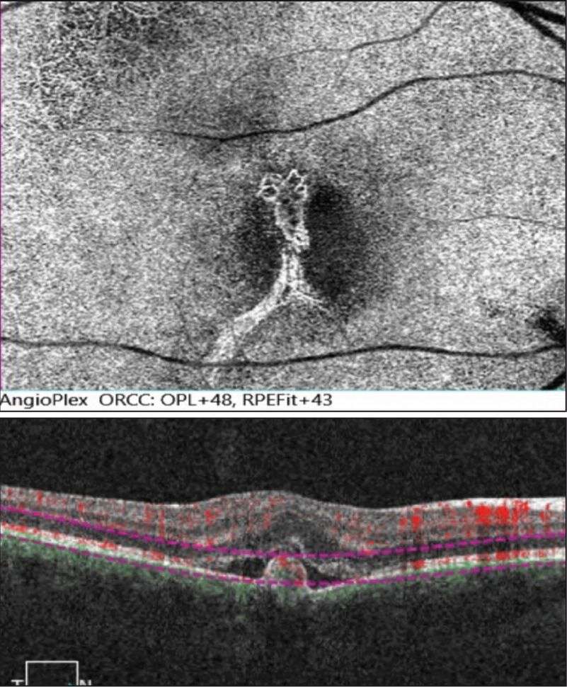 Figure 5. OCT-A en segmentation « rétine externe choriocapillaire » à la visite initiale : néovaisseau visible composé d’un tronc nourricier central avec 2 branches filles, dont une supérieure avec un aspect en « glomérule » entourée d’un halo sombre et une inférieure en arbre mort. 
