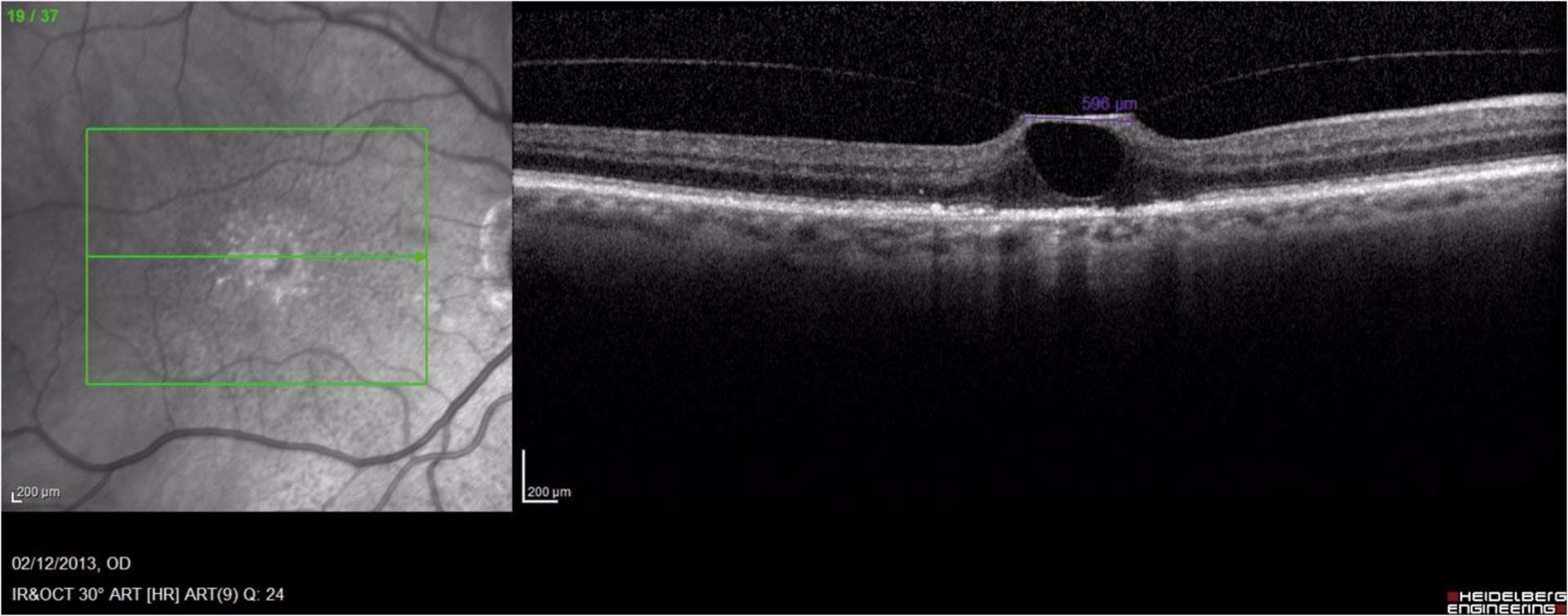 Traction vitréo-maculaire focale avec cavitation de la rétine interne.
