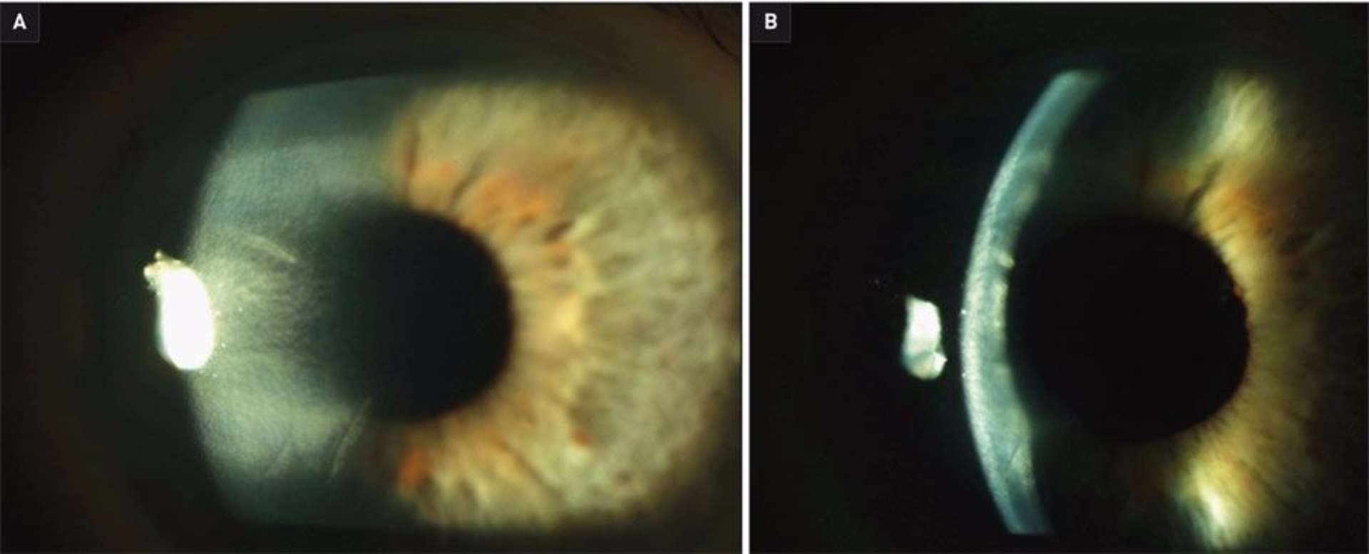 Figure 1. Examen à la lampe à fente de face (A) et en coupe (B).
