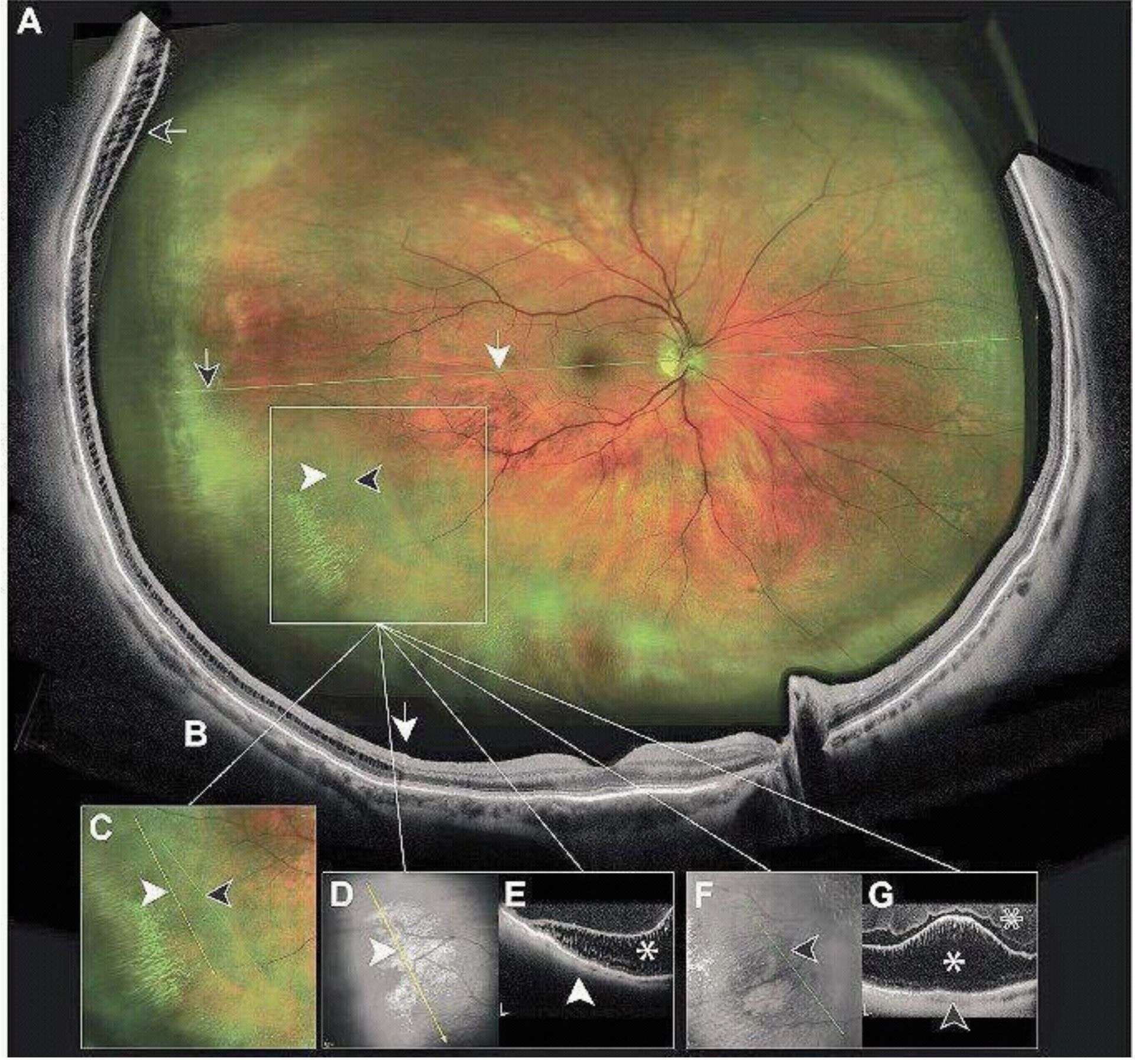 Figure 2. Rétinoschisis imagé en imagerie multimodale ultra grand champ. Par M. Streho
