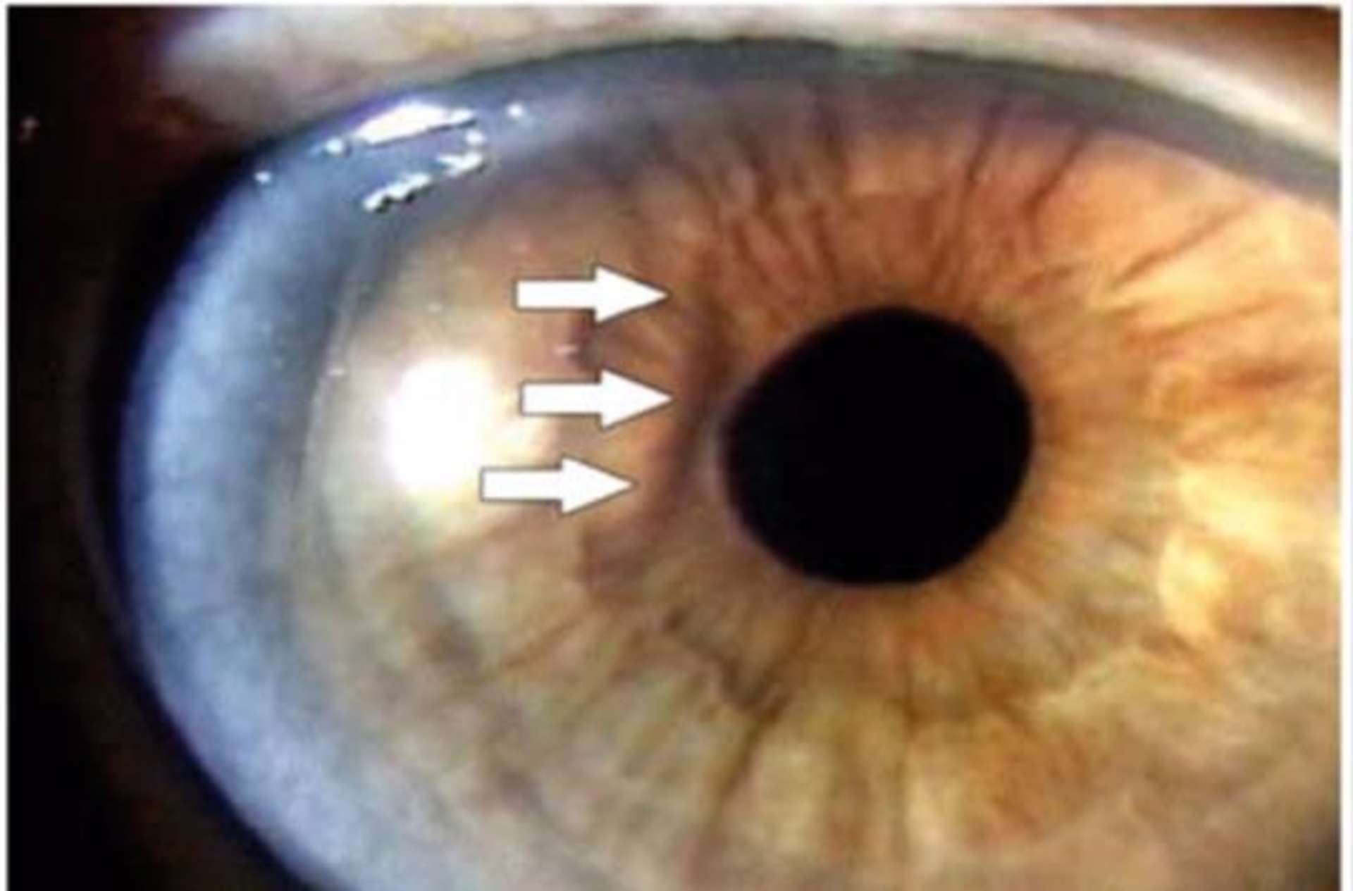 Une ligne d’ombre temporale apparaît lors d’une projection de lumière oblique par rapport à l’incision temporale (d’après Osher RH [5]).
