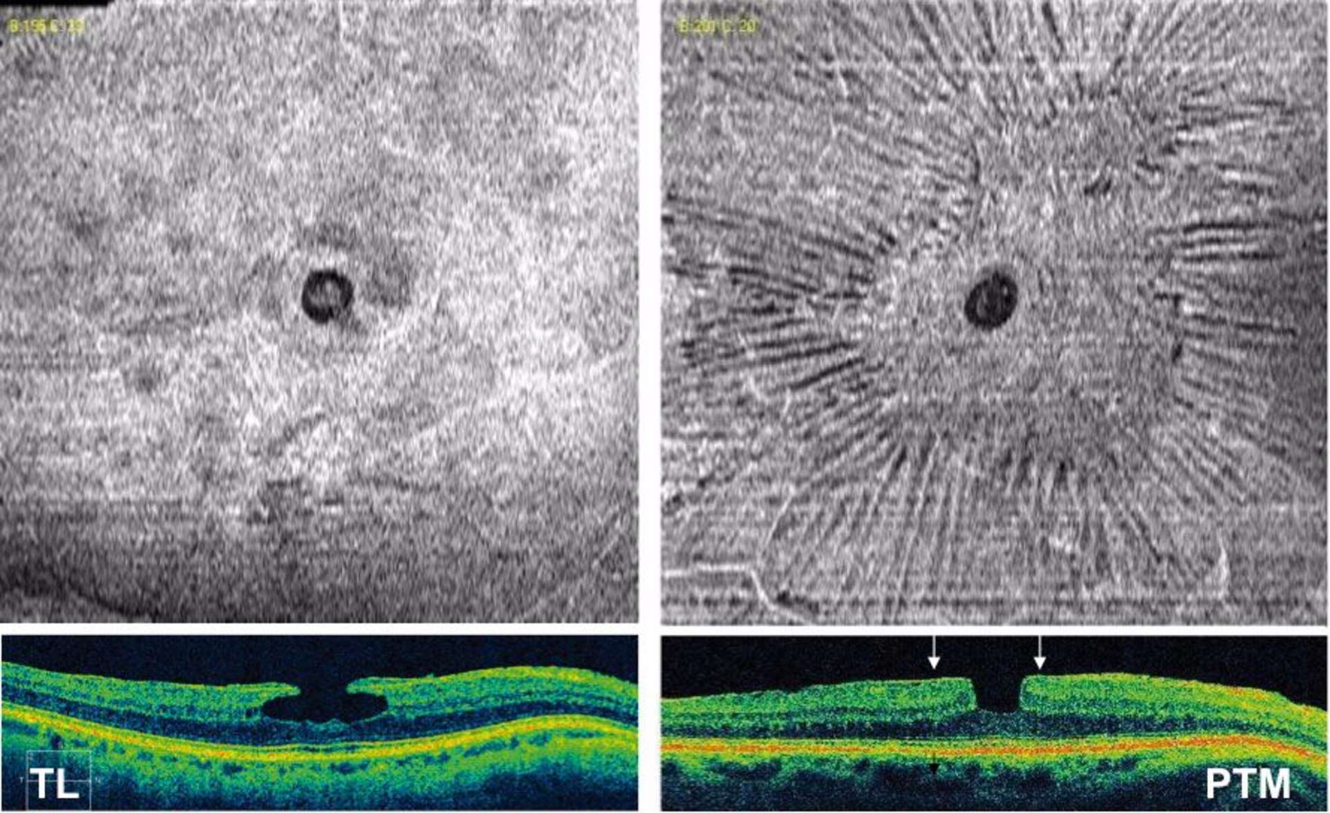 Le diagnostic différentiel est relativement facile quand il s’agit d’un PTM à bords réguliers verticalisés et droits (à droite) : il existe un épaississement maculaire et le fond est d’épaisseur normale. L’image en face montre une MER lisse au centre avec des plis rétiniens radiaires traduisant les forces de contraction centripètes. À gauche, il s’agit d’un TL avec un fond irrégulier et aminci et l’épaisseur maculaire est normale. Il y a une très fine membrane visualisable, mais l’image en face de l’OCT montre une surface lisse sans contraction de cette membrane (images de l’hôpital Lariboisière).
