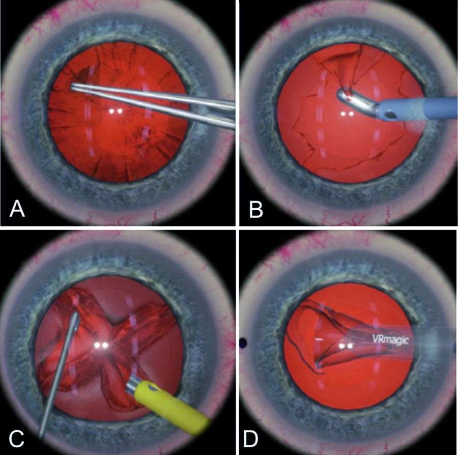 Figure 2. Les différentes étapes de la phako-émulsification telles qu’elles sont perçues par l’apprenant dans les oculaires du simulateur Eyesi.
