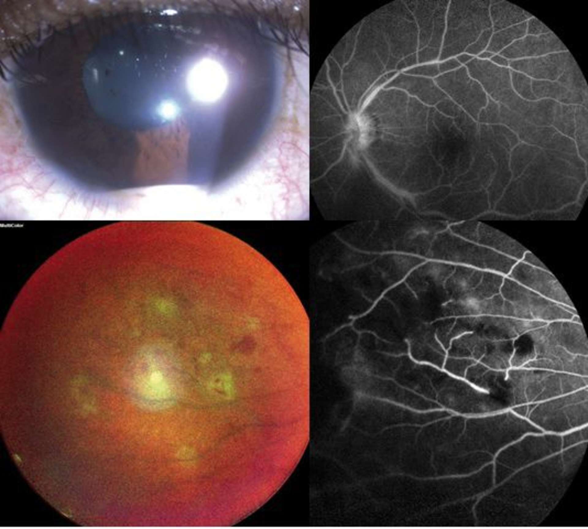 Figure 3. OG. Panuvéite unilatérale non granulomateuse à hypopion avec foyers de rétinite périphériques chez un homme de 40 ans ayant une aphtose buccale. Après qu’il a été établi que la recherche de virus dans l’humeur aqueuse était négative, un traitement par corticothérapie et interféron alpha-2 a permis une cicatrisation totale des foyers de rétinite et une récupération visuelle à 9/10. Les zones d’ischémie rétinienne périphérique ont été traitées secondairement par panphotocoagulation rétinienne. 
