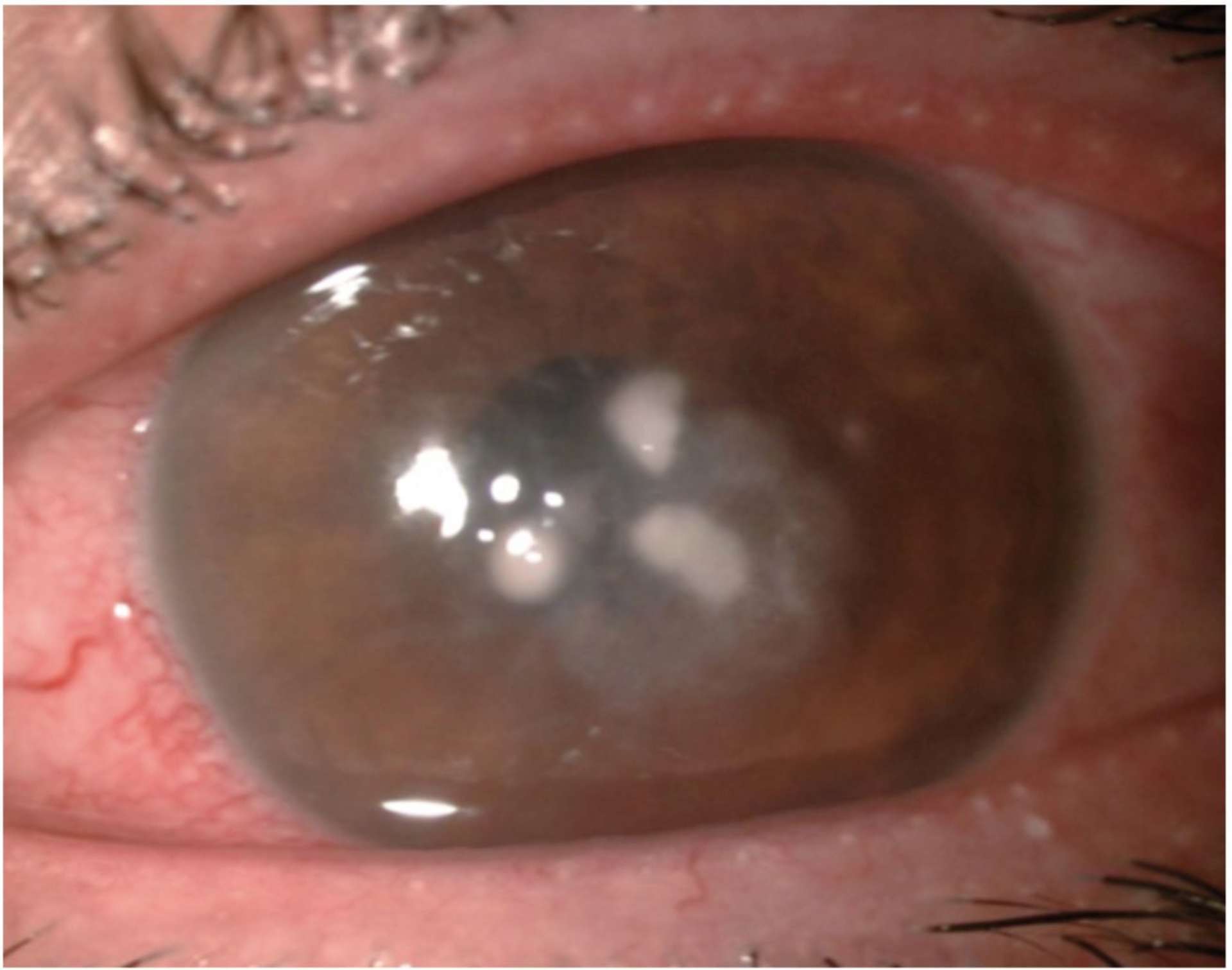 Figure 4A. Kératite fongique à Fusarium chez un menuisier après un trauma par corps étranger.
