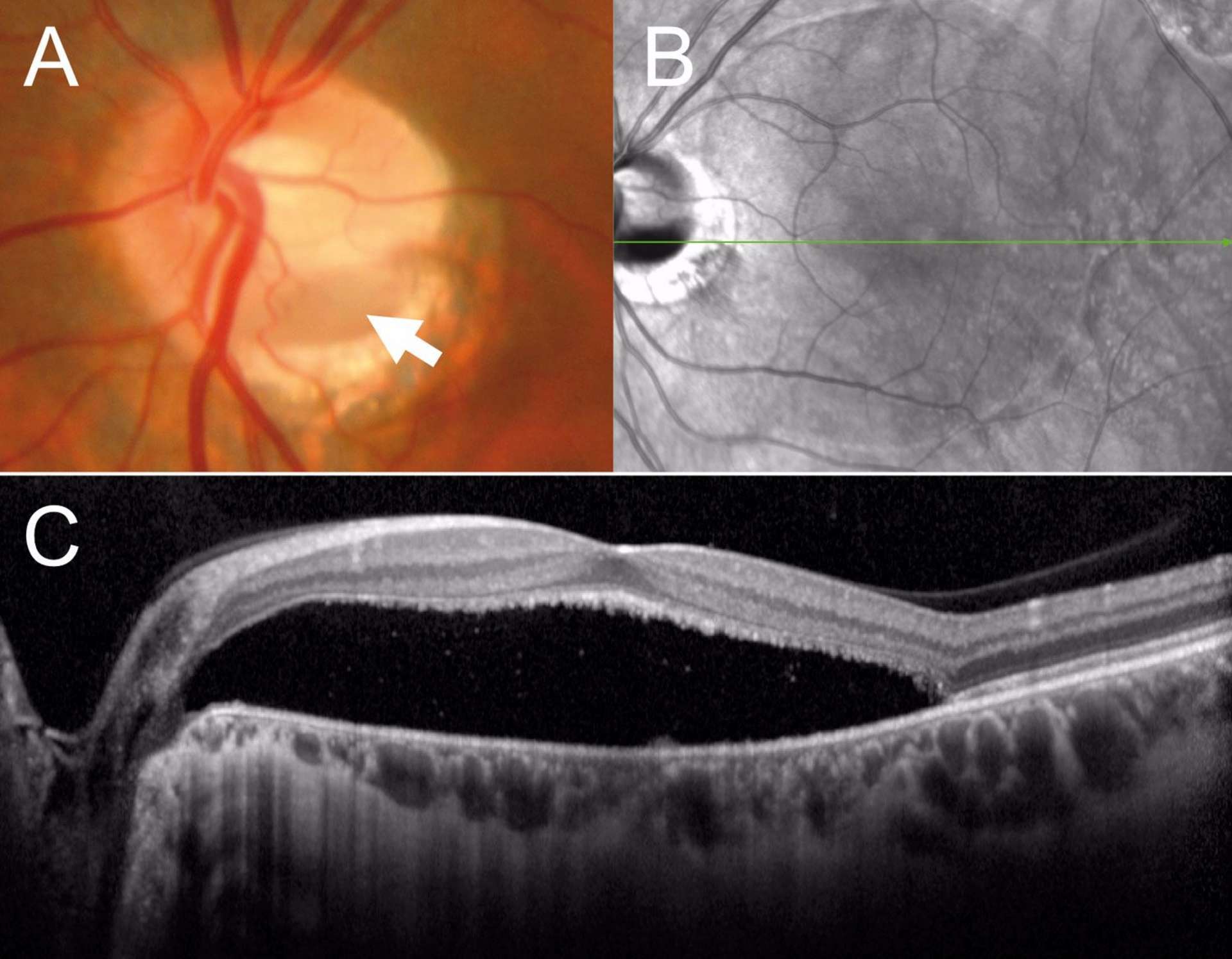 Figure 3. Figure 3. Fossette colobomateuse de la papille. A. Photographie de la papille montrant une encoche (flèche blanche). B. Cliché infrarouge montrant la coupe de l’OCT (flèche verte). C. Coupe OCT horizontale montrant un important DSR maculaire allant jusqu’à la papille.A. Photographie de la papille montrant une encoche (flèche blanche). B. Cliché infrarouge montrant la coupe de l’OCT (flèche verte). C. Coupe OCT horizontale montrant un important DSR maculaire allant jusqu’à la papille.
