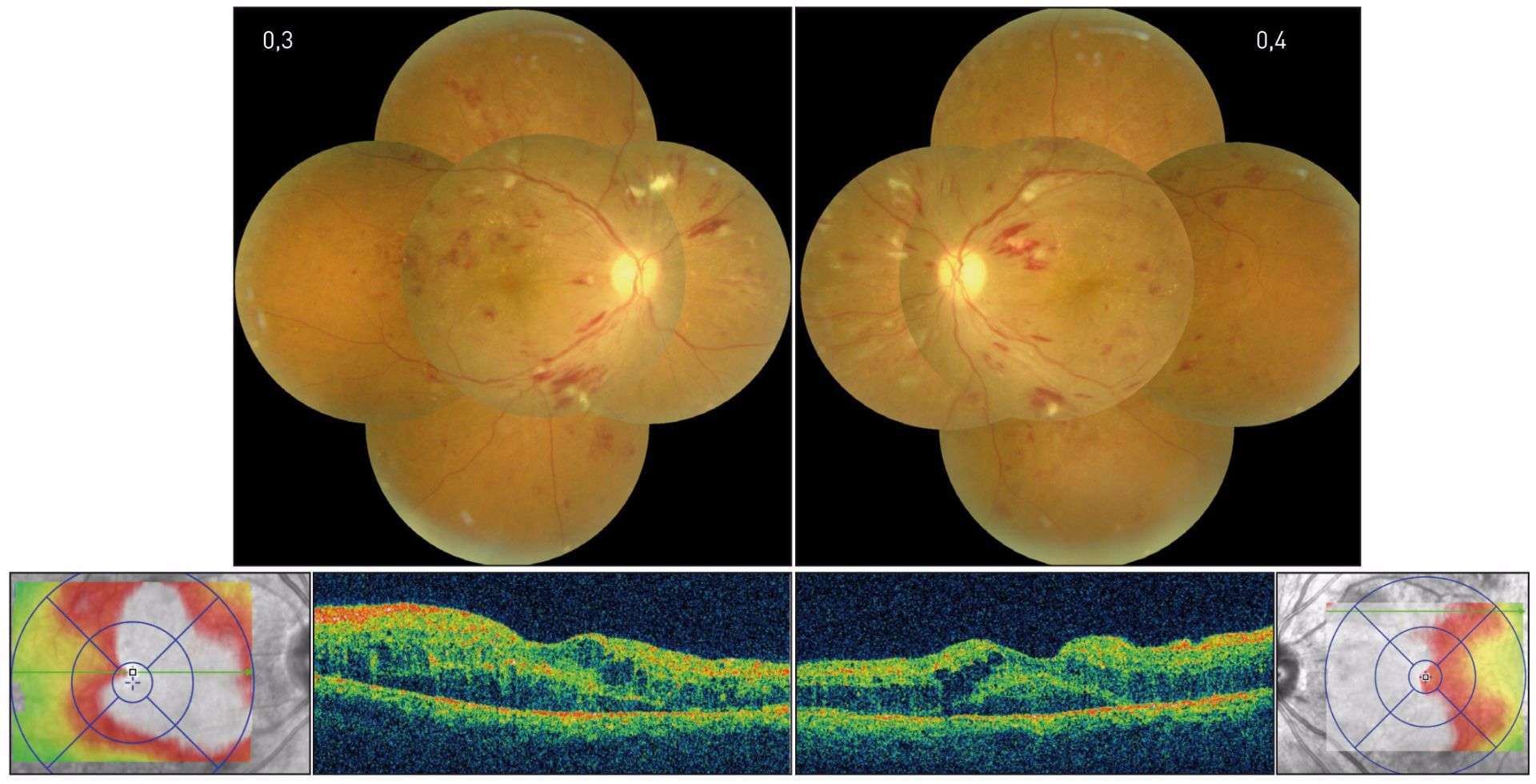 Figure 1. Patient diabétique de type 2 présentant une baisse visuelle bilatérale en relation avec un œdème maculaire bilatéral. Panoramique couleur : présence d’une rétinopathie diabétique non proliférante modérée, majorée de façon évidente par une rétinopathie hypertensive, comme en atteste la présence de nombreux nodules cotonneux, d’hémorragies en flammèches péripapillaires ainsi que des rétrécissements artériolaires. L’aspect en OCT est également évocateur avec la présence d’un décollement séreux rétinien et la prédominance de l’épaississement maculaire dans la région inter-papillomaculaire. Il existe une indication à traiter en urgence l’hypertension artérielle de ce patient avant d’envisager un traitement par injections intravitréennes pour l’OMD.
