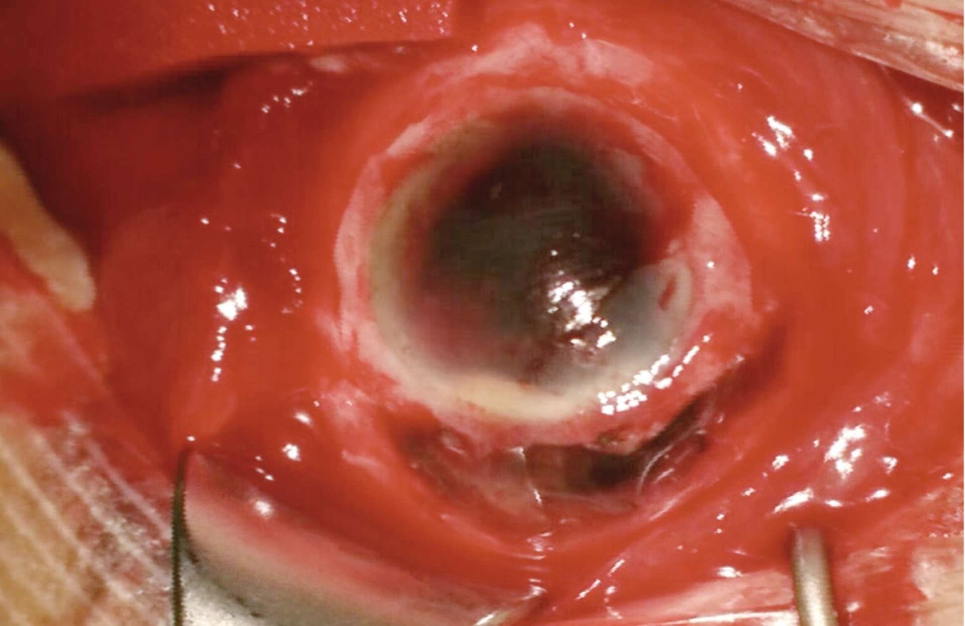 Figure 3. Exploration de la plaie au bloc opératoire : mise en évidence d’une large plaie sclérolimbique supérieure masquée initialement par le chémosis hémorragique.
