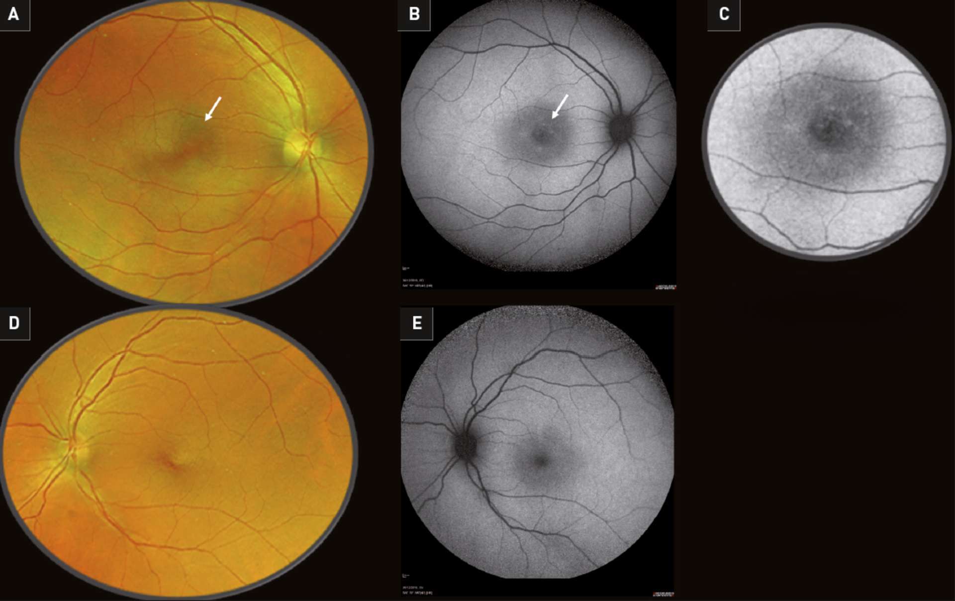 Figure 1. Imagerie multimodale de la rétine. A. Rétinophotographie ultra grand champ (Optos®) de l’œil droit, la flèche montre la bulle de DSR. B. Cliché en autofluorescence de l’œil droit indiquant les zones d’hyper-autofluorescence réticulées. C. Zoom sur l’image B. D. Rétinophotographie ultra grand champ (Optos®) de l’œil gauche. E. Cliché en autofluorescence de l’œil gauche.
