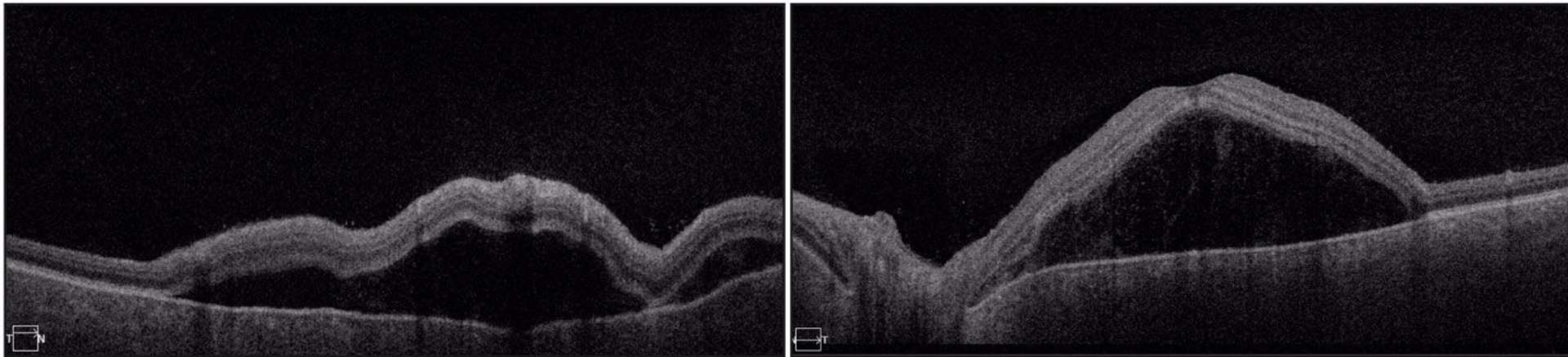 Figure 2. OCT-SS au diagnostic. DSR maculaires aux 2 yeux.
