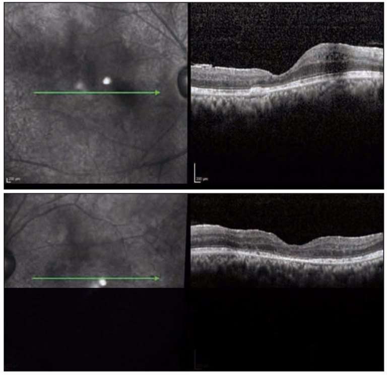 Figure 2. Ischémie maculaire bilatérale chez un patient de 45 ans ayant une maladie de Behçet entraînant une acuité visuelle à 1/10 aux 2 yeux.

