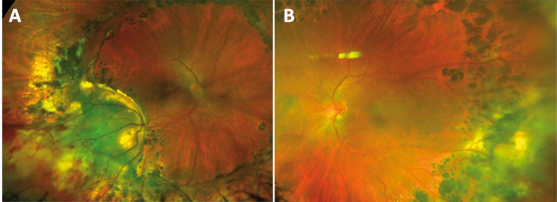 Figure 2. Clichés couleurs ultra grand champ après traitement. Quelques semaines après photocoagulation à l’endolaser des télangiectasies de la périphérie temporale de l’œil gauche, celles-ci sont encore englobées dans l’œdème blanchâtre de la brûlure du laser (B). À droite, il persiste des anomalies vasculaires qui peuvent être traitées au laser à la lampe à fente (A).
