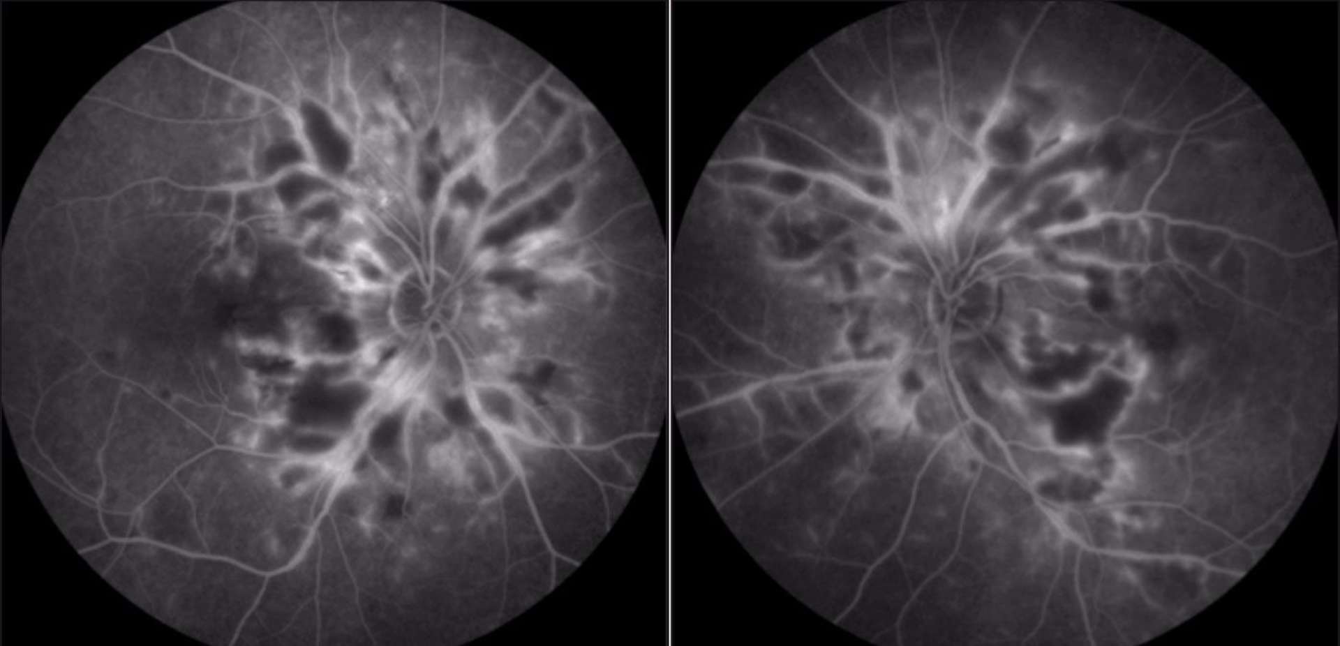 Figure 3. Angiographie à la fluorescéine, temps tardif.
