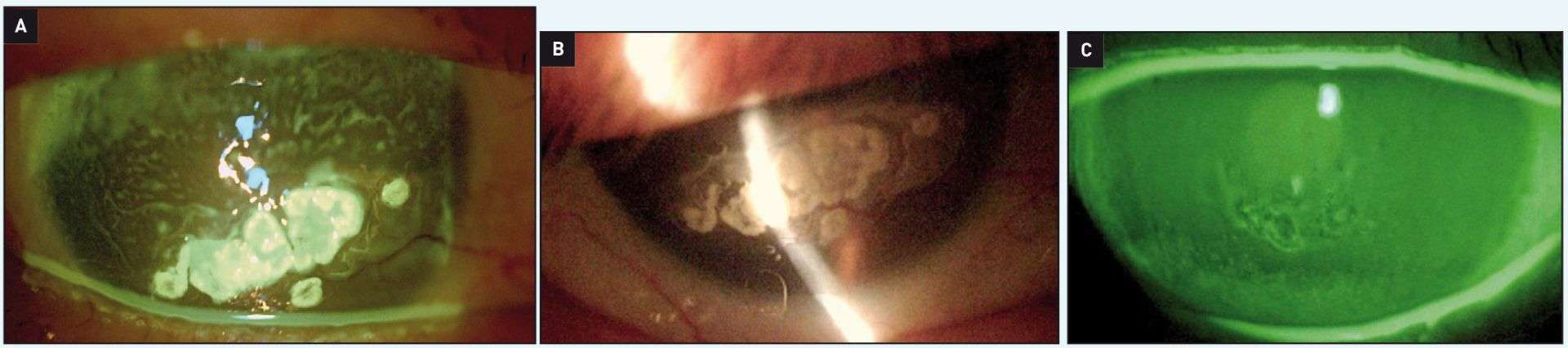 Les douleurs accompagnant sa kératite en bandelette (A) ont cédé à la pose d’une lentille en lotrafilcon de puissance nulle et de rayon 8,40 (B). Après 4 ans, l’état de surface cornéen s’est nettement amélioré (C).
