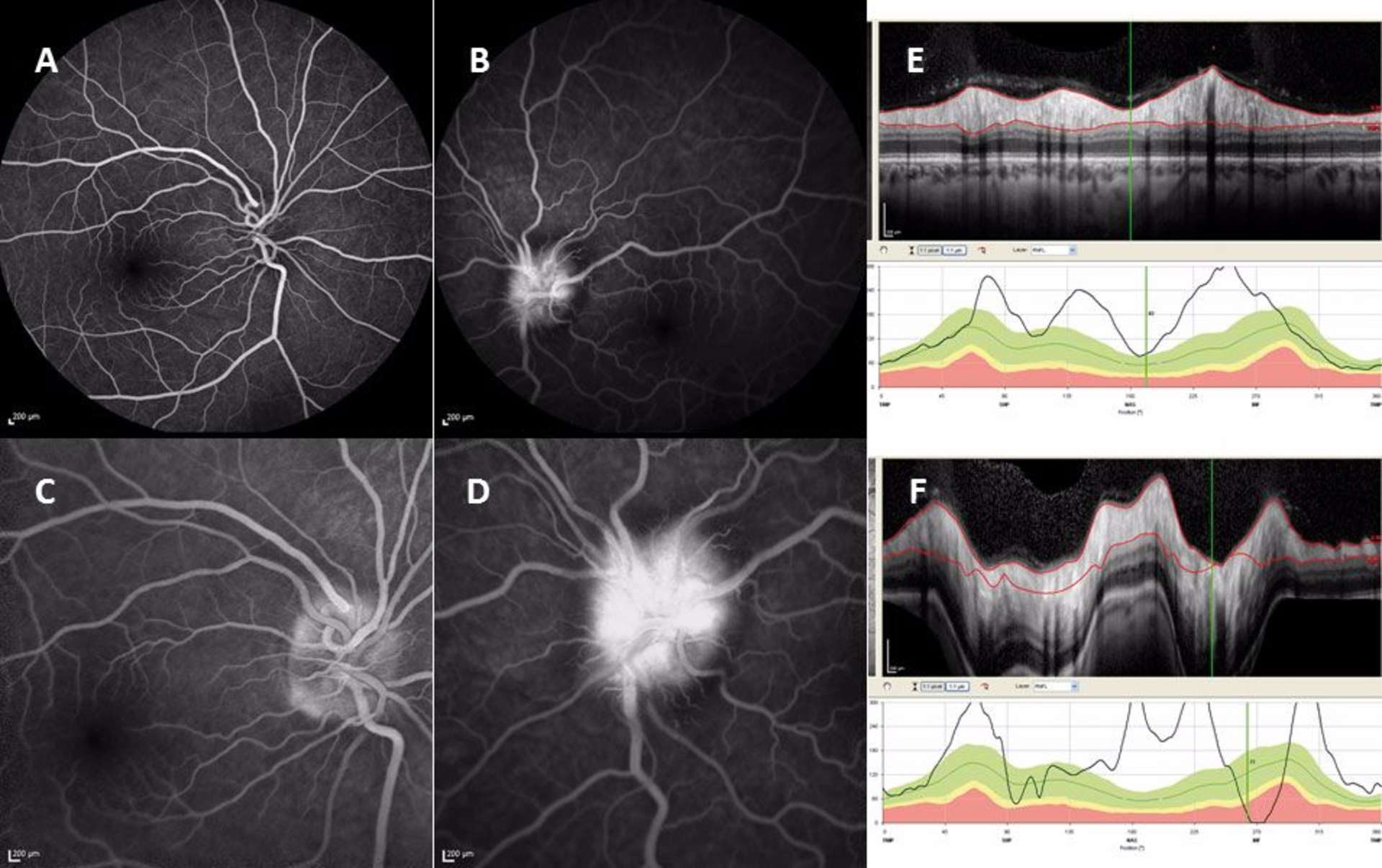 A-D. Angiographie à la fluorescéine : imprégnation modeste de la papille droite à l’injection de fluorescéine ; imprégnation et diffusion majeure de la papille gauche. E-F. Analyse RNFL en OCT SD : œdème papillaire droit et gauche.
