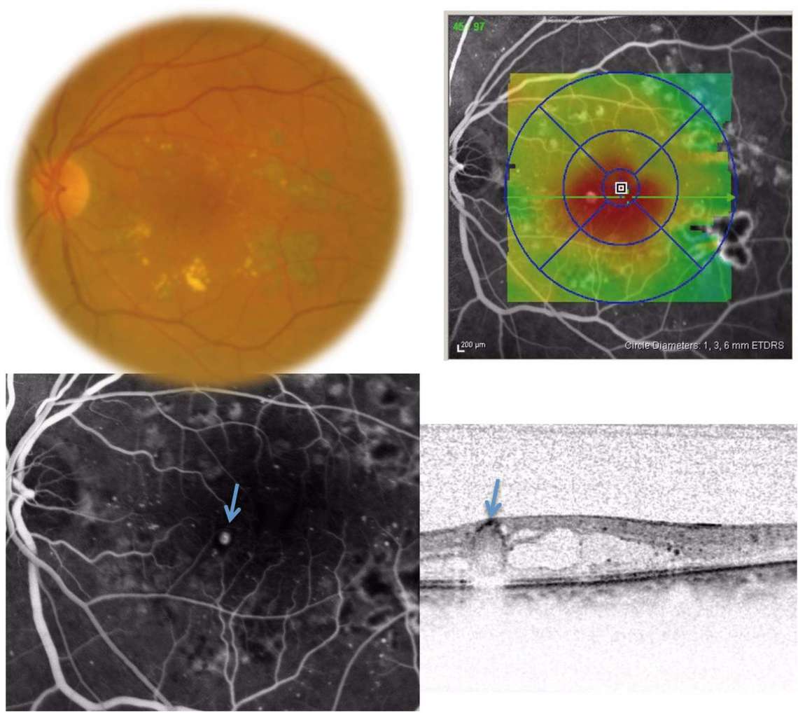 Figure 3. Imagerie multimodale d’une télangiectasie capillaire au cours d’un œdème maculaire diabétique antérieurement traité par laser. L’ICG et l’OCT permettent une bonne visualisation de la lésion (flèche).
