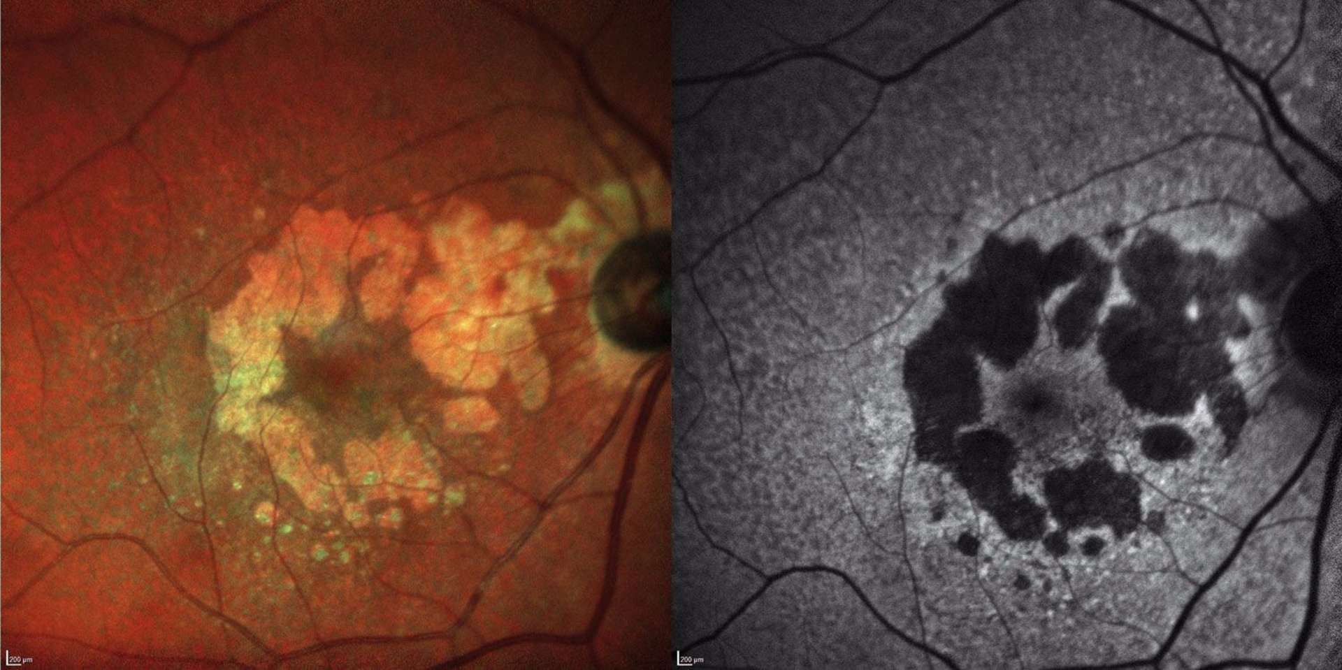 Figure 1. Clichés Multicolor® et autofluorescence d’une atrophie géographique.
